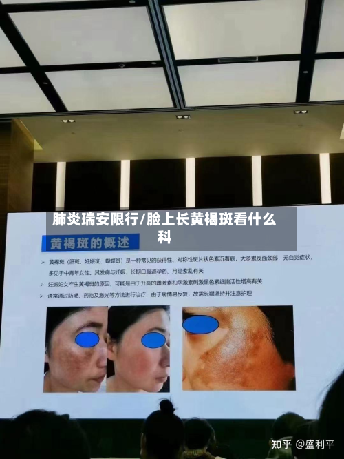 肺炎瑞安限行/脸上长黄褐斑看什么科-第3张图片