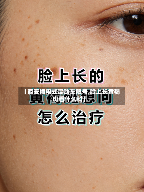 【西安插电式混动车限号,脸上长黄褐斑看什么科】