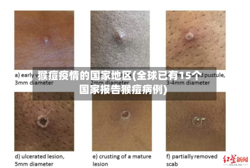 猴痘疫情的国家地区(全球已有15个国家报告猴痘病例)