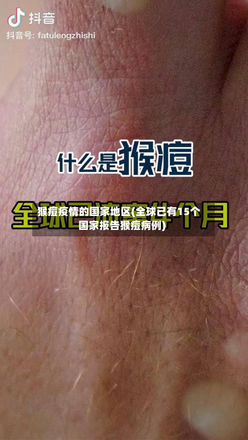 猴痘疫情的国家地区(全球已有15个国家报告猴痘病例)-第2张图片