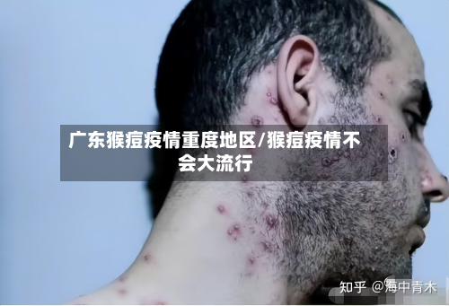 广东猴痘疫情重度地区/猴痘疫情不会大流行